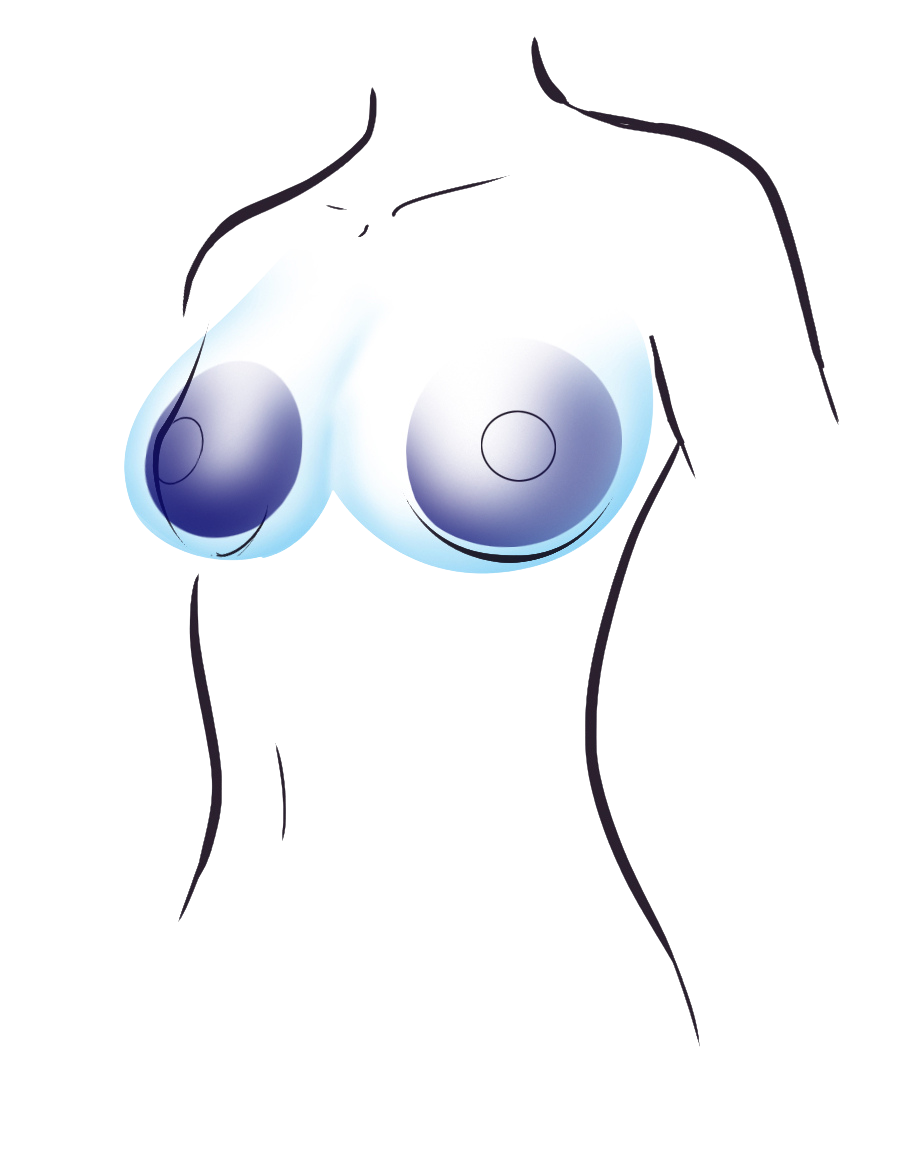 Preserve Motiva Implantate. Ein Image Bild zeigt eine Siluette einer Frau mit den Brustimplantaten von Motiva